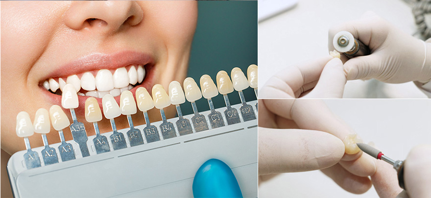 排齦、備牙、倒凹、調整咬合…為了讓修復體使用更久、更美觀,堅決杜絕毫厘偏差!